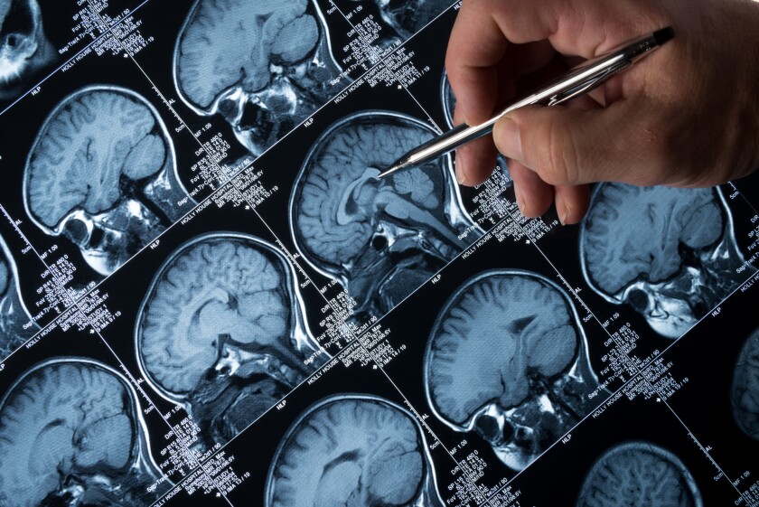 A doctor points a pen at brain scans for someone with a Alzheimer's diagnosis