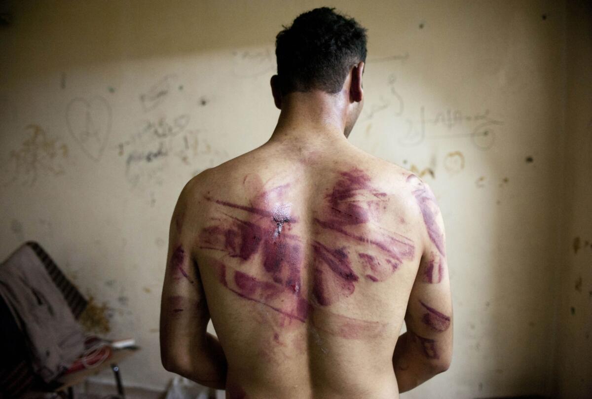 A Syrian man in Aleppo, released after being held by government forces, shows the marks of torture on his back.