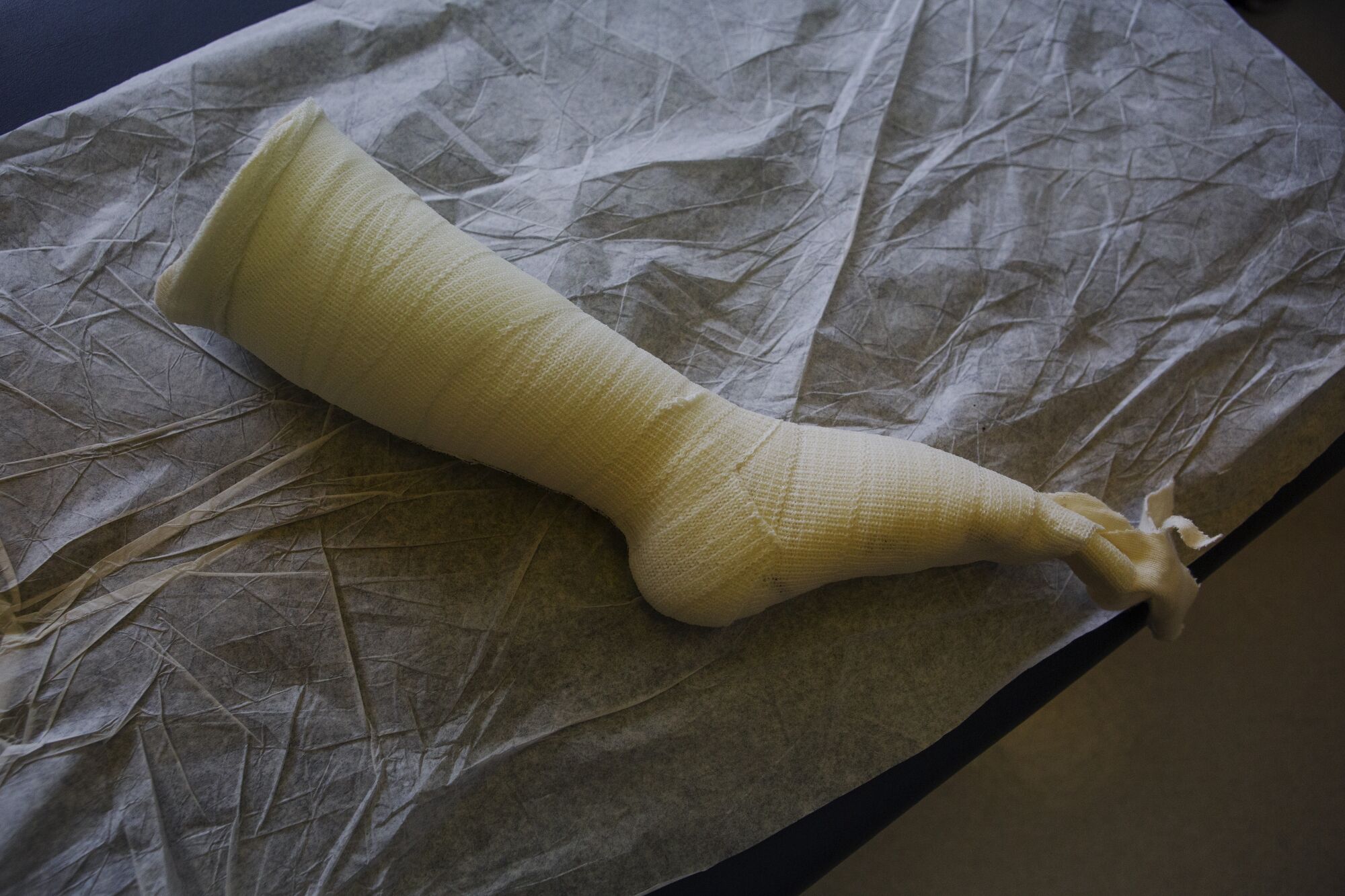 A cast of Efraín's foot lays on a hospital bed.