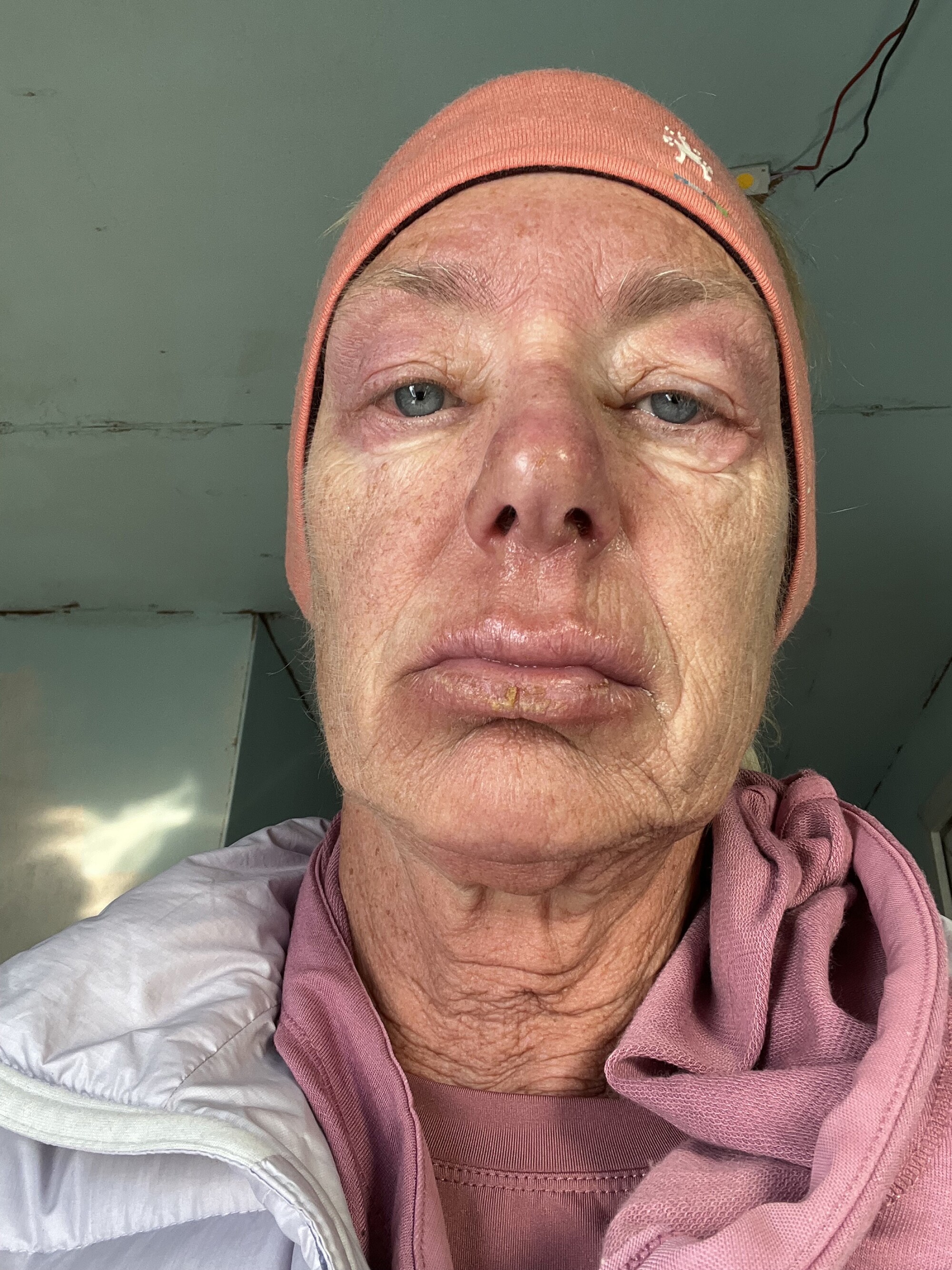 A woman's selfie shows her weary face, red, swollen and chapped from the altitude, cold and wind.