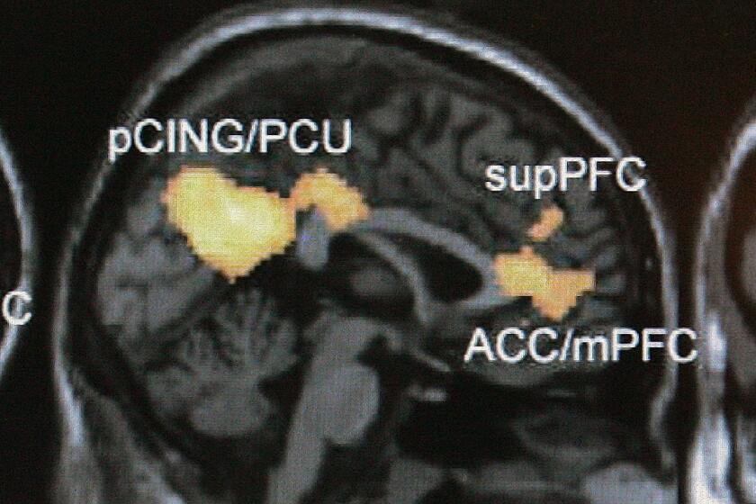 FILE - This Jan. 30, 2006 file photo shows a functional magnetic resonance imaging scan on a computer screen at an Emory University lab in Atlanta. Using large magnets, the scans detect where oxygenated blood flows, allowing scientists to indirectly measure brain activity. Researchers are becoming increasingly critical of some brain scan studies that purport to show exactly how our minds shape our behavior. (AP Photo/Ric Feld, File)