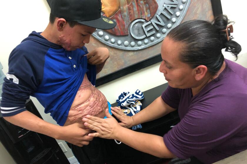 Flor de María Paz muestra las quemaduras que su hijo, David López, tiene en su abdomen sufridas en mayo de 2019.