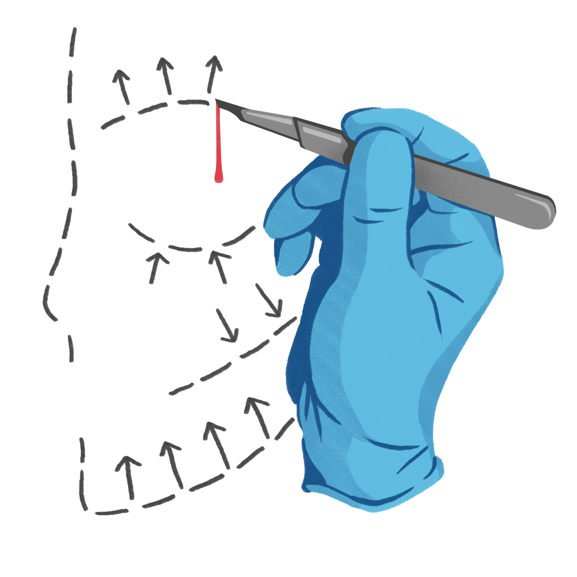 L'illustration conceptuelle montre le scalpel du chirurgien et les lignes pointillées
