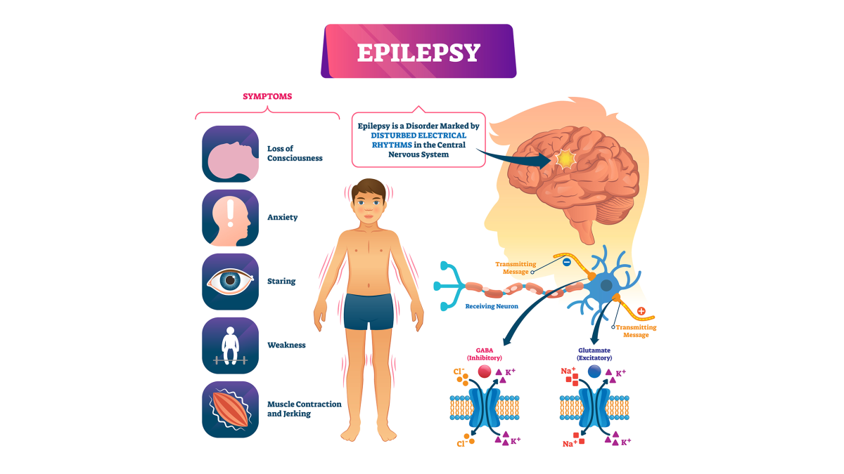 Epilepsy vector illustration. Labeled sick CNS disorder educational scheme, and image of epilepsy symptoms and causes.
