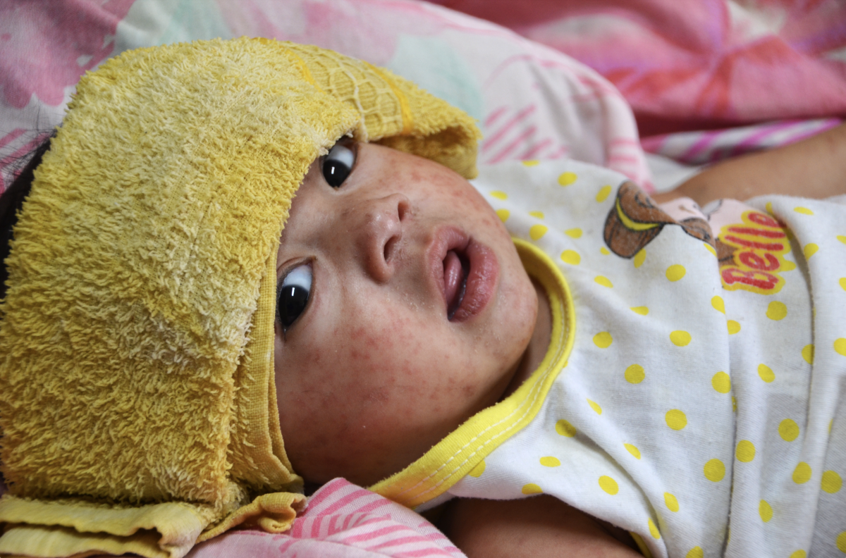 Coronavirus Today: The individuals who face the best COVID danger 3 A baby hospitalized with measles.